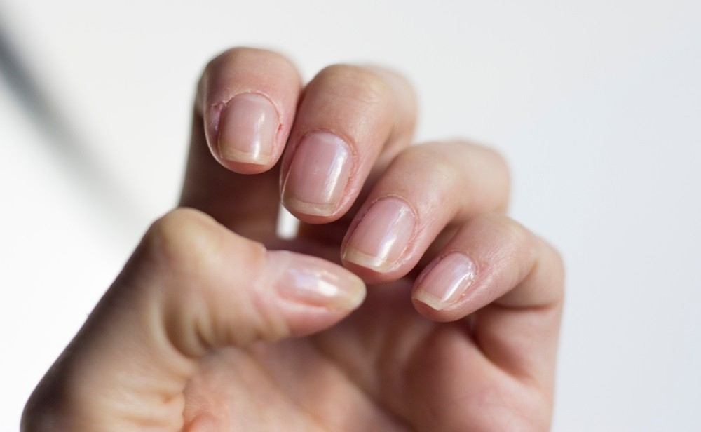 white-spots-on-nails-leukonychia-how-to-get-rid-of-these-health