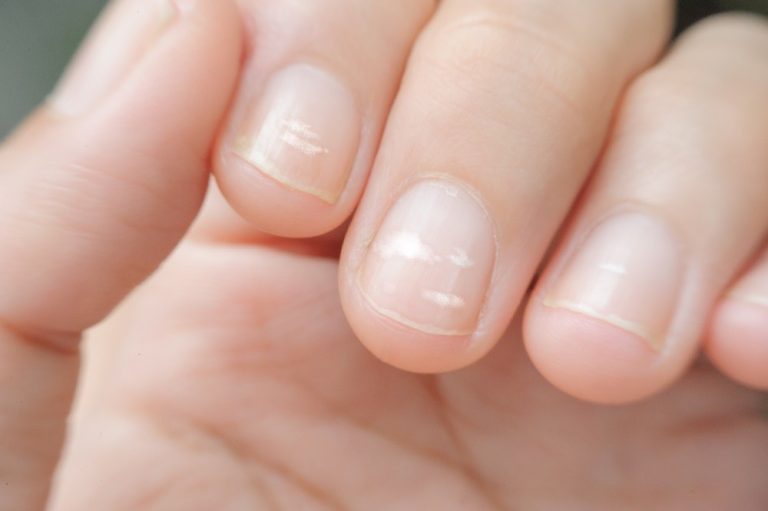 why-your-fingernails-have-white-spots-and-how-to-remove-them-maby-blog