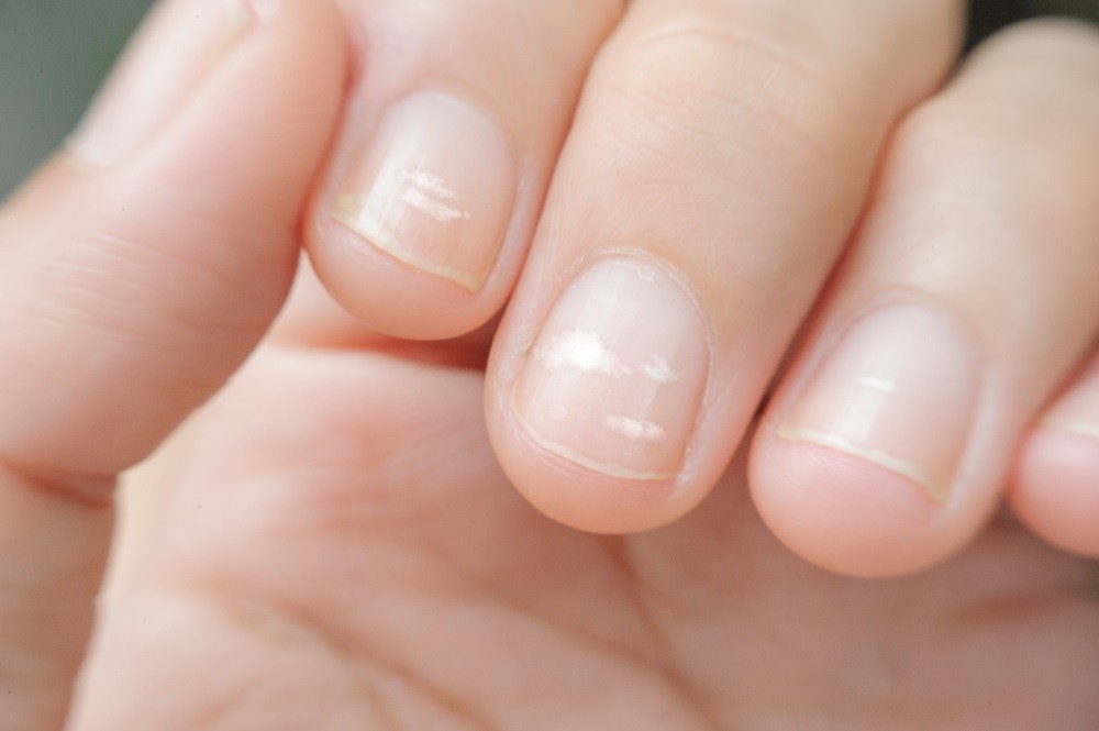 Why Your Fingernails Have White Spots And How To Remove Them - Maby Blog