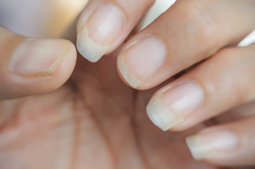 You Shouldn't Ignore These Warning Signs Of Unhealthy Nails - Maby Blog